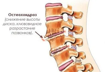 Остеохондроза, нейните видове и лечение