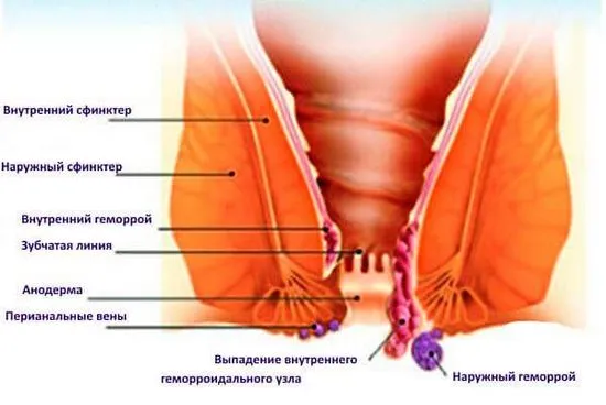 хемороиди