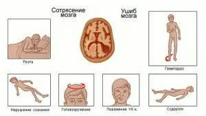 Симптоми и лечение на мозъчно сътресение