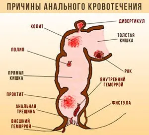 Какво да правим с кървене от хемороиди