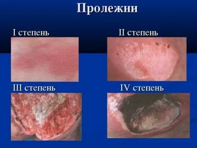 Как да се лекуват рани от залежаване при лежащо болни: мехлеми, лекарства, кремове, препарати