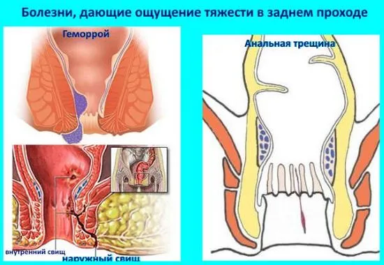 Какво причинява тежест в ануса