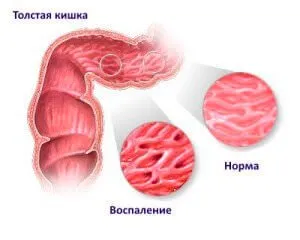 заболяванията