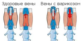 Преглед на медицински трикотаж Venoteks (Venoteks)