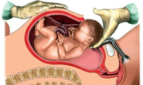 Анестезия при цезарово сечение, коя анестезия е за предпочитане