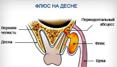 Fluxul dentar la fel de rapid pentru a elimina tumora și ce să facă atunci când apare