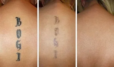 Cum să eliminați un tatuaj cu un laser, rețete acasă fără cicatrici. Fotografii înainte și după