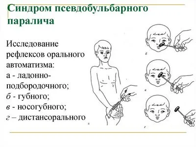 Причини, симптоми и лечение на псевдобулбарен синдром при възрастни и деца