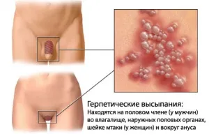 Tratamentul herpesului genital al bolii la femei și bărbați