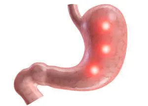 Simptome de ulcer gastric atunci când este nevoie de ajutor de urgență