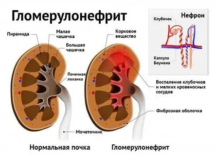 glomerulonefritei