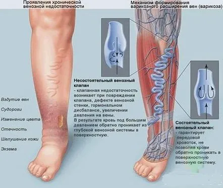 Cauzele insuficienței venoase cronice și modul de tratare a bolii