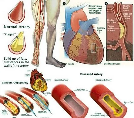 ateroscleroza