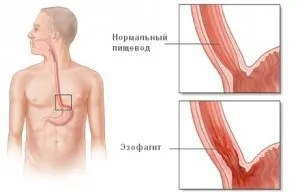 Simptome, semne, tratament esofagită