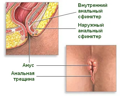 Cum să tratezi o fisura anală a rectului