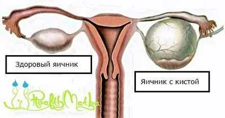 Cum să tratezi chisturile ovariene, ale sânilor și cervicale