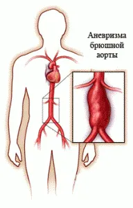 Remedii populare pentru prevenirea și tratamentul anevrismului