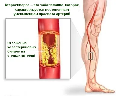 Tratamentul medical și prevenirea aterosclerozei