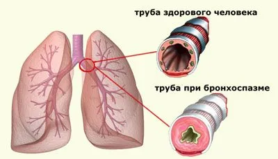 Cauzele dezvoltării bronhospasmului, tabloul clinic al unui atac. Modalități de a elimina spasmul