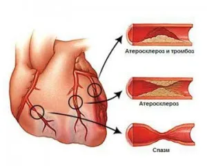 Ateroscleroza aortei, ce este și cum se tratează boala