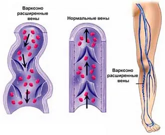 Prevenirea venelor varicoase ale membrelor în timpul muncii sedentare