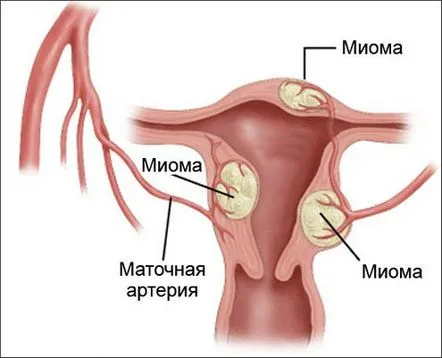 Cum să tratezi fibromul uterin Simptome, cauze și fotografii