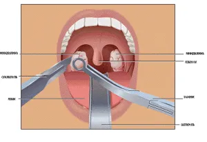 Îndepărtarea amigdalelor este necesară pentru amigdalita cronică