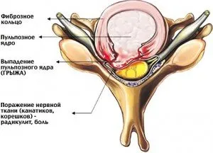 Hernia coloanei cervicale