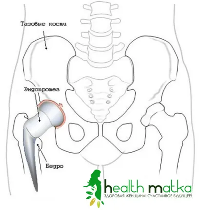 Tratamentul patologiei articulației șoldului