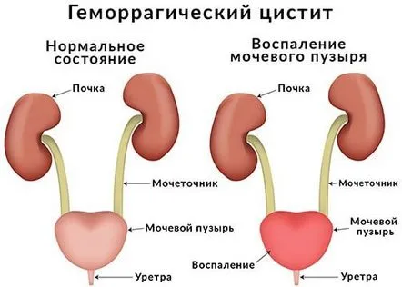 Cistita hemoragica la femei si copii, simptome si tratament