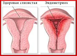 Endometrioza. Tratament cu remedii populare