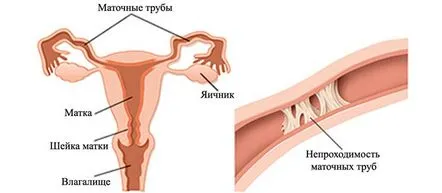 Semne de obstrucție a trompelor uterine, laparoscopie și alte metode de diagnostic