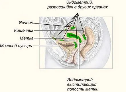 endometrioza