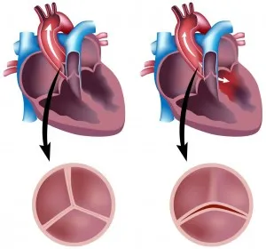 Valva aortică bicuspidă este un defect cardiac congenital