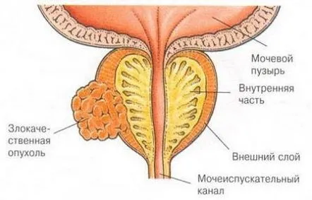 Simptome, reguli de tratament și prognostic în cancerul de prostată