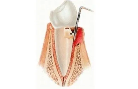 Cauzele și tratamentul parodontitei acute