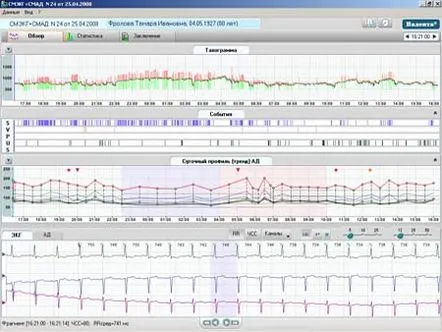 Cum se efectuează monitorizarea Holter ECG, caracteristicile și descrierea acesteia