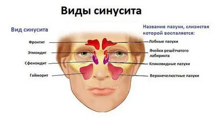 Алергични ринити симптоми и лечение на капки за нос, спрейове, лекарства, народни средства за защита,