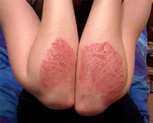 psoriazisului