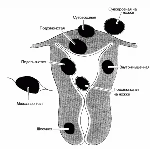 Tinctura pentru tratamentul fibromului uterin