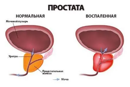 Simptomele și tratamentul prostatitei bacteriene cronice