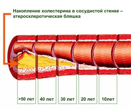 Curățarea vaselor de sânge de colesterolul rău din sânge este prevenirea bolilor de inimă