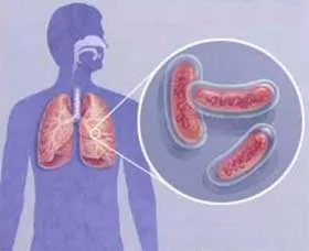 Tuberculoză, pericol infecțios pentru toți cei din jur