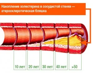 Ce este ateroscleroza cerebrală a vaselor cerebrale