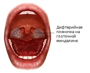 Difteria este o boală contagioasă și foarte periculoasă