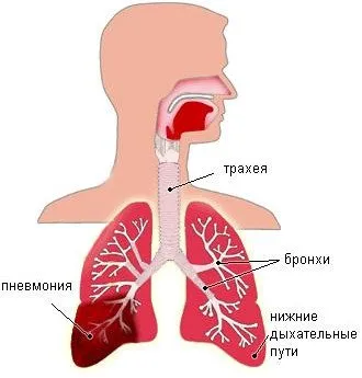 Pneumonie croupoasă