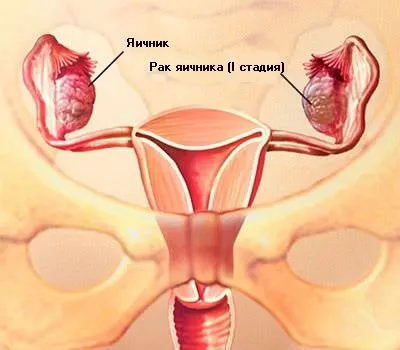 4 etape ale cancerului ovarian - semnele, cauzele și tratamentul lor