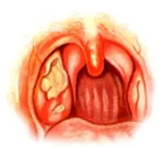 Mononucleoza infecțioasă înfricoșătoare și periculoasă la copii