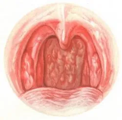 Simptomele și tratamentul faringitei hipertrofice