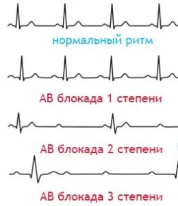 Blocarea atrioventriculară principalele cauze și simptome ale bolii